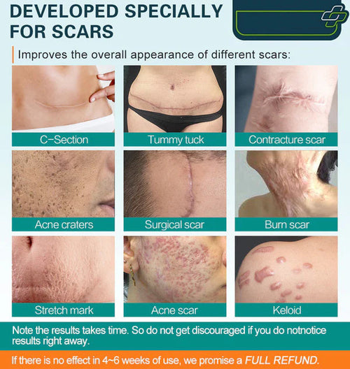 An advanced scar spray for all types of scars including acne scars, surgical scars, stretch marks, etc. 